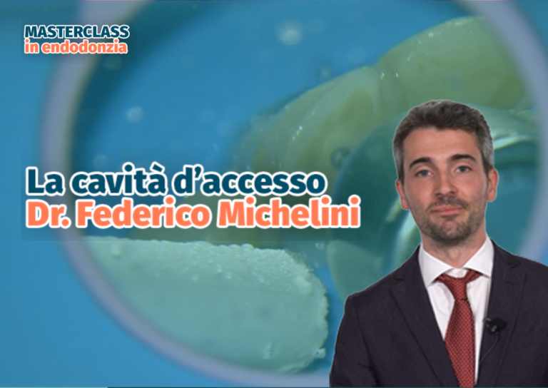 Le cavità d’accesso “custom” in endodonzia