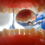 Revisione della classificazione dei sistemi adesivi per generazione, numero di fasi e strategia adesiva Adesivi dentali