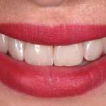 Reverse Maryland un’alternativa nella riabilitazione orale di edentulismi in area estetica Reverse Maryland