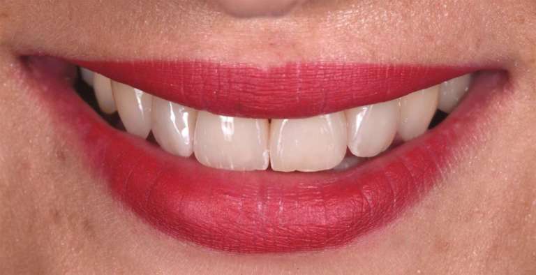 Fluoruro simbiotico è biocompatibile e migliora la remineralizzazione dello smalto