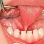 Classificazione e management dei frenuli patologici nell’infanzia frenuli patologici infanzia