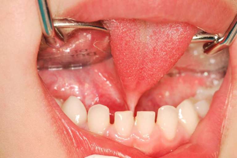 Classificazione e management dei frenuli patologici nell’infanzia