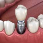 Aspetti chiave del sistema conometrico nella riabilitazione implanto-protesica