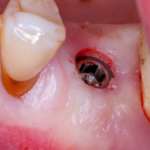 Preservazione dell’alveolo postestrattivo per una riabilitazione implanto-protesica predicibile