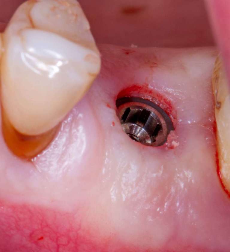 Preservazione dell’alveolo postestrattivo per una riabilitazione implanto-protesica predicibile