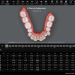 La tecnica Invisalign dopo 25 anni: predicibilità clinica e workflow digitale