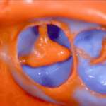 La diagnosi cavitaria in conservativa: un modello dinamico di terapia