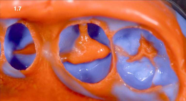 La diagnosi cavitaria in conservativa: un modello dinamico di terapia