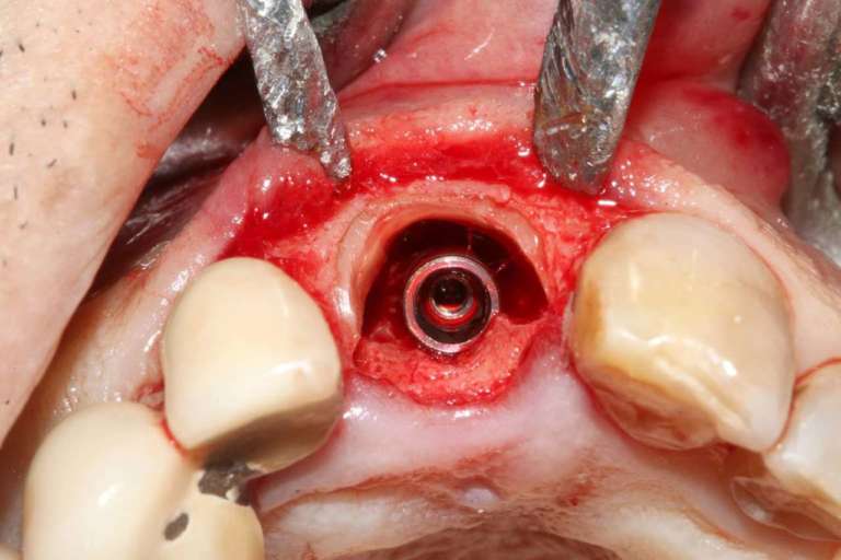 Socket-shield o P.E.T. (Partial extraction therapy)