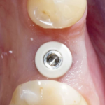 Preservare i volumi alveolari dopo l’estrazione di un premolare per inserire un impianto differito