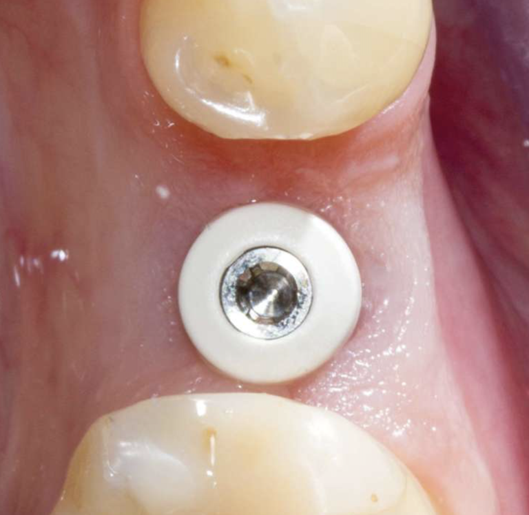 Preservare i volumi alveolari dopo l’estrazione di un premolare per inserire un impianto differito