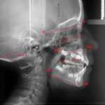 La trazione extraorale alta nel trattamento dell’open bite scheletrico