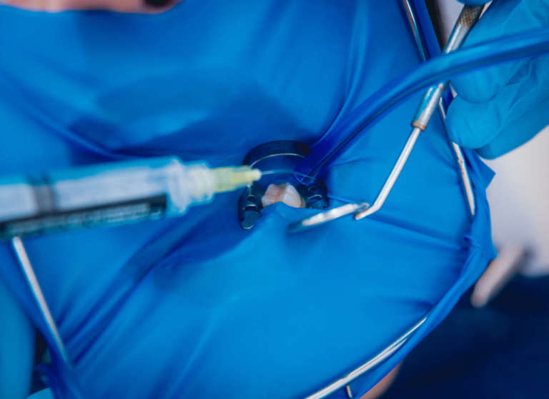 Terapia endodontica: i principali errori in fase di apertura di camera pulpare