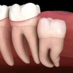 Autotrapianto nuovi protocolli e follow-up a lungo termine