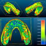 Utilizzo clinico di allineatori associati a metodica nuvola® Op System: studio retrospettivo su 100 pazienti