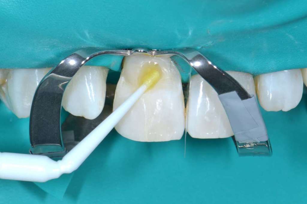 Riassorbimento cervicale invasivo