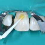 Odontoiatria restaurativa, come sta andando il mercato globale Riassorbimento cervicale invasivo