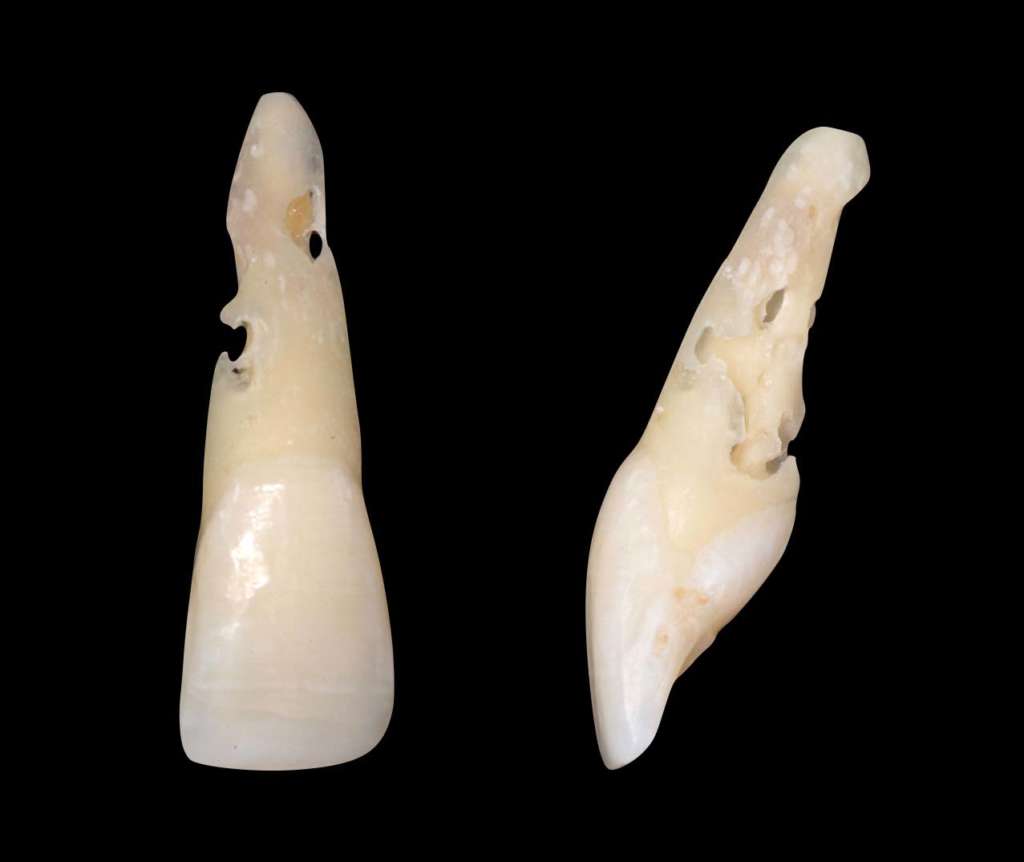 Riassorbimento cervicale invasivo