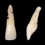 Il riassorbimento cervicale invasivo esterno: lo stato dell’arte Riassorbimento cervicale invasivo