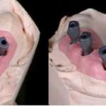 Valutazione dell’operatore-dipendenza nelle scansioni full-arch su impianti