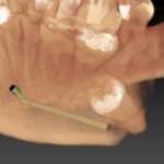 Enucleazione di estesa neoformazione associata a elemento dentario in inclusione profonda