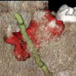 Tecnica tradizionale e piezoelettrica nella chirurgia di un elemento incluso complesso