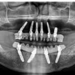 Avanti veloce: ecco perché il sistema implantare SKY fast & fixed è all’altezza del suo nome