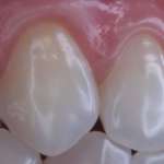 Malattia perimplantare: le relazioni tra materiali e biofilm