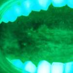 Cancro orale: intercettazione e diagnosi precoce