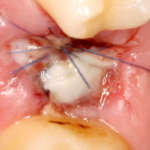 Rigenerazione di alveolo post-estrattivo con PRGF®-Endoret® e carico immediato di impianti corti nei settori posteriori della mascella Rigenerazione di alveolo post-estrattivo