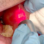 Applicazioni laser in odontoiatria: revisione narrativa della letteratura scientifica e case report