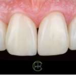 Riabilitazioni estetiche minimamente invasive: il ruolo dell’allineatore trasparente settoriale