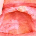 Salute orale e diagnosi precoce. Il ruolo dell’odontoiatra nelle patologie orali