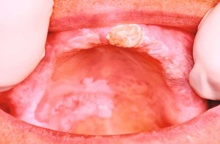 Salute orale e diagnosi precoce. Il ruolo dell’odontoiatra nelle patologie orali