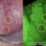 La diagnosi di natura delle lesioni orali sospette