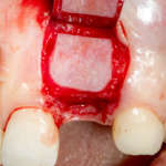 Riabilitazione implanto-protesica complessa dopo la rimozione di un impianto in zona estetica