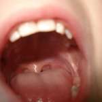 Infezioni gravi della bocca, batteri censiti da ricercatori svedesi