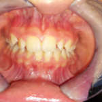 Il bruxismo nei bambini. Cosa sappiamo realmente?