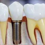 Prossimità impianto-dente, uno studio ne valuta la prognosi