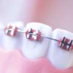 Peptidoma salivare e proteasi in un trattamento ortodontico