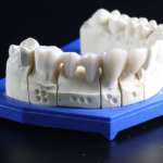 Paziente edentulo con palatoschisi, i vantaggi di una riabilitazione protesica