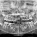 Valutazione della prevalenza di agenesie dentali tramite ortopantomografie in un campione di residenti in Lombardia e in Piemonte
