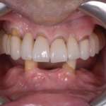 Riabilitazione mandibolare full-arch con impianti monocomponente