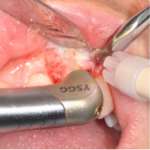 Impianti post-estrattivi in siti infetti decontaminati con laser Er,Cr:YSGG: evidenze scientifiche Impianti siti infetti laser