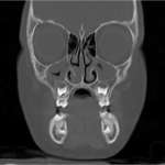 Gestione del paziente pediatrico con sospetto diagnostico di sindrome delle apnee ostruttive del sonno