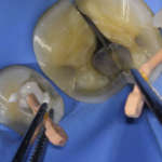 Endodonzia: sigilli vecchi e nuovi a confronto