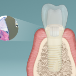 Peri-implantite: oggi evitabile grazie alle ultime tecnologie Peri-implantite evitabile
