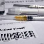 Lichen planus orale, i migliori trattamenti messi a confronto