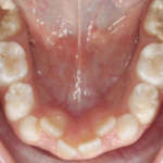 Molar Incisor Hypomineralization: gestione e principi di terapia con i materiali bioattivi