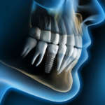 Chirurgia guidata: impianti dentali, i vantaggi della pianificazione digitale chirurgia guidata